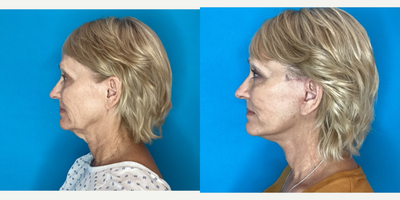 Facelift before and after photo