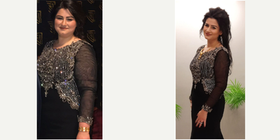 Gastric Sleeve Surgery before and after photo