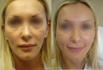 Sculptra before and after photo