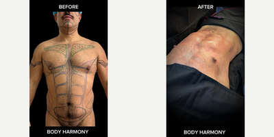 Abdominal Etching before and after photo