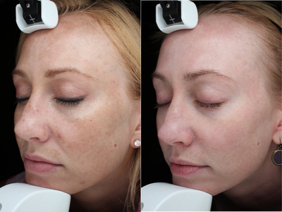 Blue Peel before and after photo