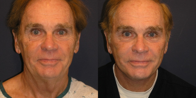 Facelift before and after photo