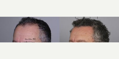 FUE Hair Transplant before and after photo