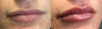 Lip Fillers before and after photo