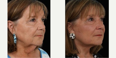 Lower Facelift before and after photo