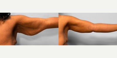 Arm Lift before and after photo
