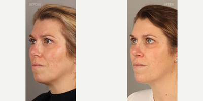 Chin Filler before and after photo
