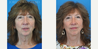 Facelift before and after photo