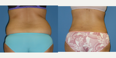 Liposuction before and after photo