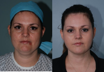 Liposuction before and after photo