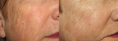 PicoWay before and after photo