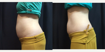 SculpSure before and after photo