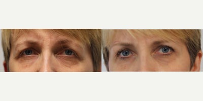 Brow Lift before and after photo