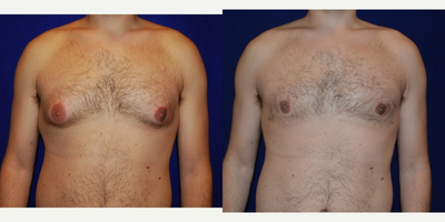 Gynecomastia Surgery before and after photo