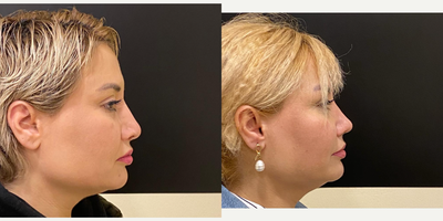 Revision Rhinoplasty before and after photo