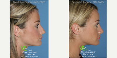 Rhinoplasty before and after photo