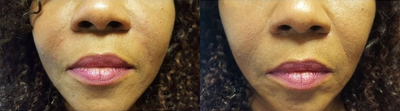 Bellafill before and after photo
