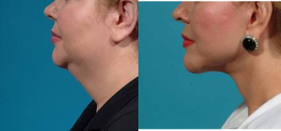 Neck Lift before and after photo