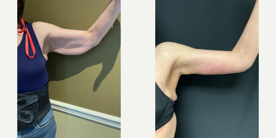 Arm Lift before and after photo