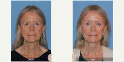 CO2 Laser before and after photo