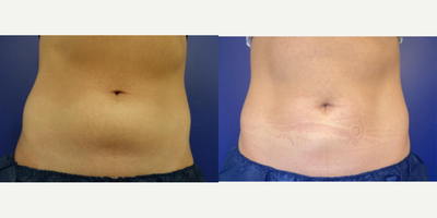 CoolSculpting before and after photo