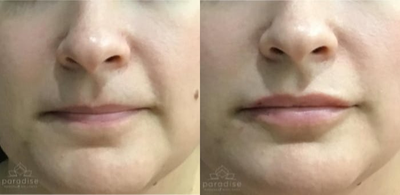 Juvederm before and after photo