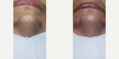 Laser Genesis before and after photo