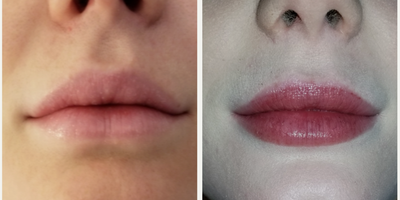 Lip Fillers before and after photo