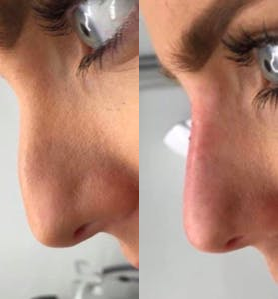 Nonsurgical Nose Job before and after photo