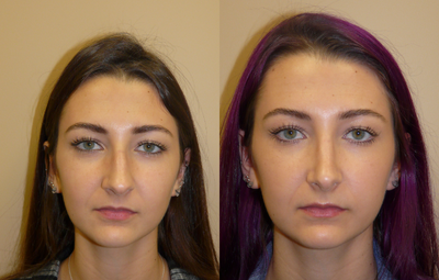 Rhinoplasty before and after photo