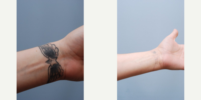 Tattoo Removal before and after photo