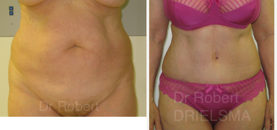 Tummy Tuck before and after photo