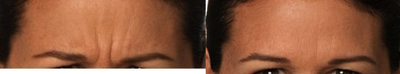 Botox before and after photo