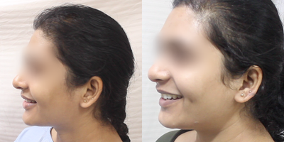 Cheek Lift before and after photo
