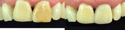 Dental Bonding before and after photo