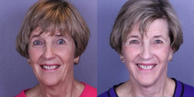 Facelift before and after photo