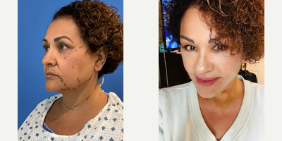 Facelift before and after photo