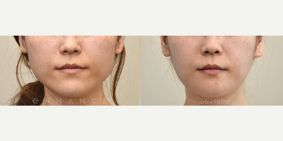 Jaw Reduction before and after photo