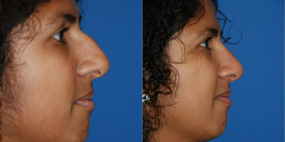 Rhinoplasty before and after photo