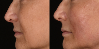 Thread Lift before and after photo