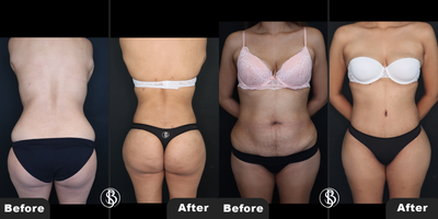 Tummy Tuck before and after photo