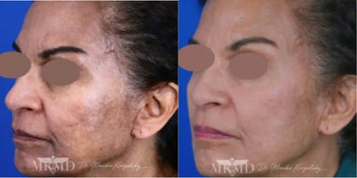 Chemical Peel before and after photo