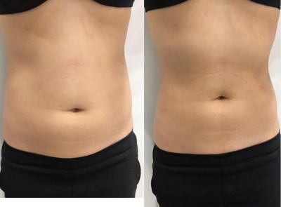 Emsculpt before and after photo