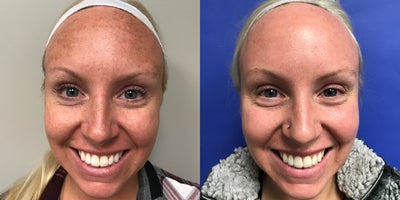 Fractora RF before and after photo