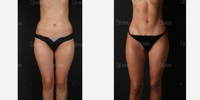 Mommy Makeover before and after photo