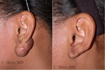 Scar Removal before and after photo