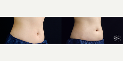 CoolSculpting before and after photo