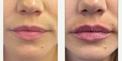 Dermal Fillers before and after photo