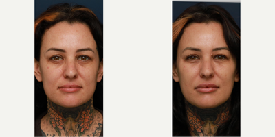 Belotero before and after photo