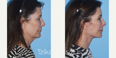Facelift before and after photo
